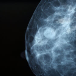 Mammogram
