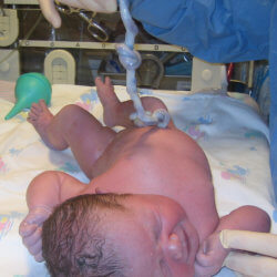 cord blood banking by drcornelius