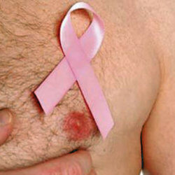 male breast cancer