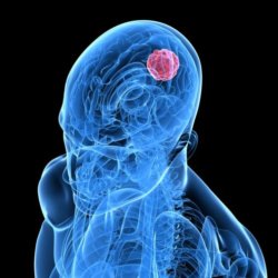 brain cancer