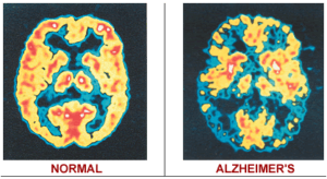 dementia-brain-scan