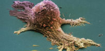 ovarian cancer cell sem steve gschmeissner