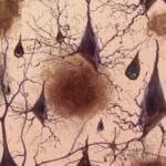Amyloid