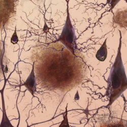 Amyloid