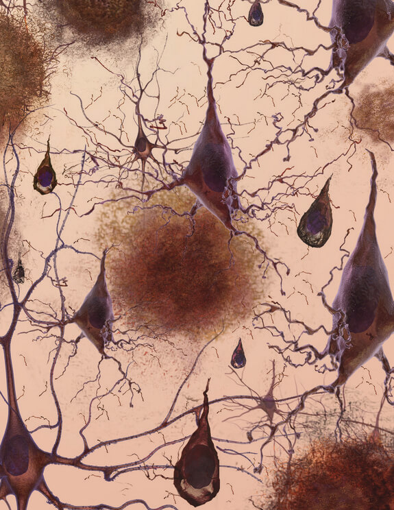 Amyloid