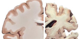 Alzheimers brain