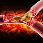 Blood blockage