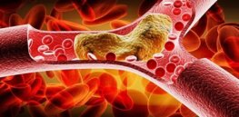 Blood blockage