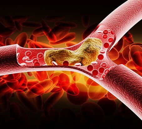 Blood blockage