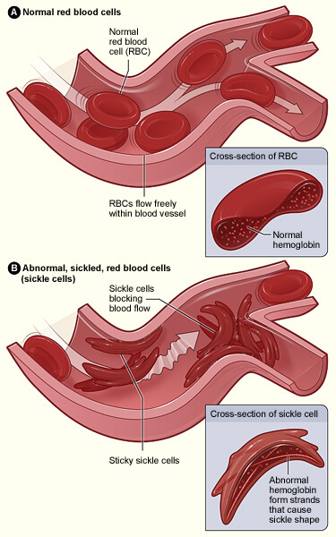 infographic-sickle-cell-disease-data