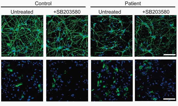 Differences in neurospheres between stem cells of two patients with schizophrenia and without schizophrenia. Credit: Takeo Yoshikawa/ RIKEN Brain Science Institute