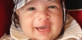 baby with cleft lip