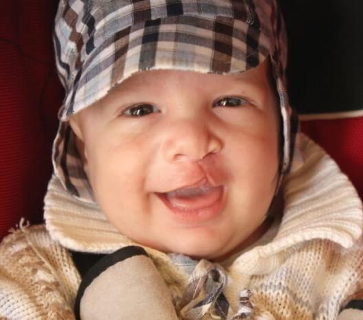baby with cleft lip