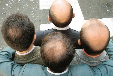 hair fall baldness x