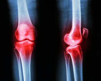 osteoarthritis of the knee