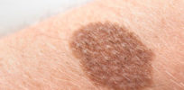 Type of skin cancer