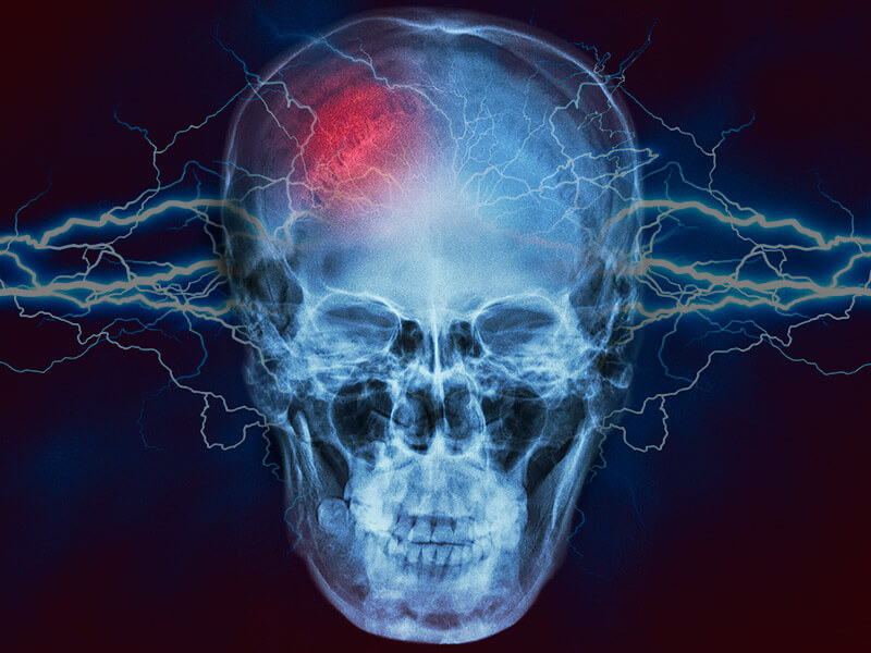 Cannabidiol for Seizures Shows Promise in New Study