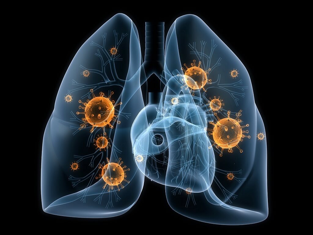 Lungs with bacteria low res