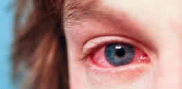 allergy