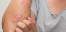 atopic dermatitis shutterstock e