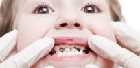 child teeth decay