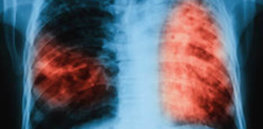 dt tuberculosis lungs x ray x