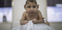 la sci sn zika birth defects
