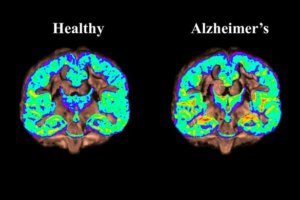 alzheimers 12 18 17 1