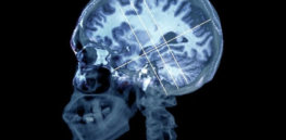 brain in alzheimers disease zephyr