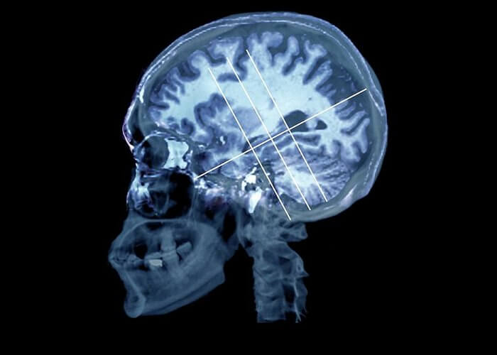 brain in alzheimers disease zephyr