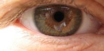 Macular degeneration patients see hope in embryonic stem cell treatment