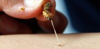 jun abelha pica braco de um paciente na fazenda de abelhas em silang nas filipinas joel magsaysay usa o veneno das abelhas para curar pacientes com doencas com