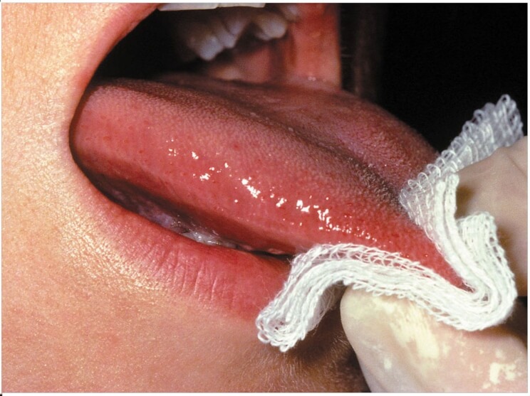 papillomavirus tongue cancer)