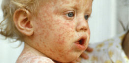 measles wide