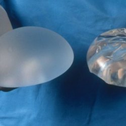 implants