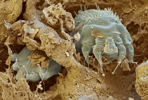 scabies