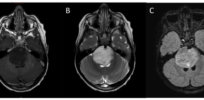 Typica l MRI appearance of DIPG A T weighted post contrast B T weighted C FLAIR