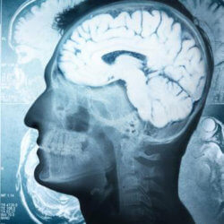 parkinsons