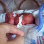 Premature infant with ventilator