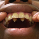 teethsupernumerary