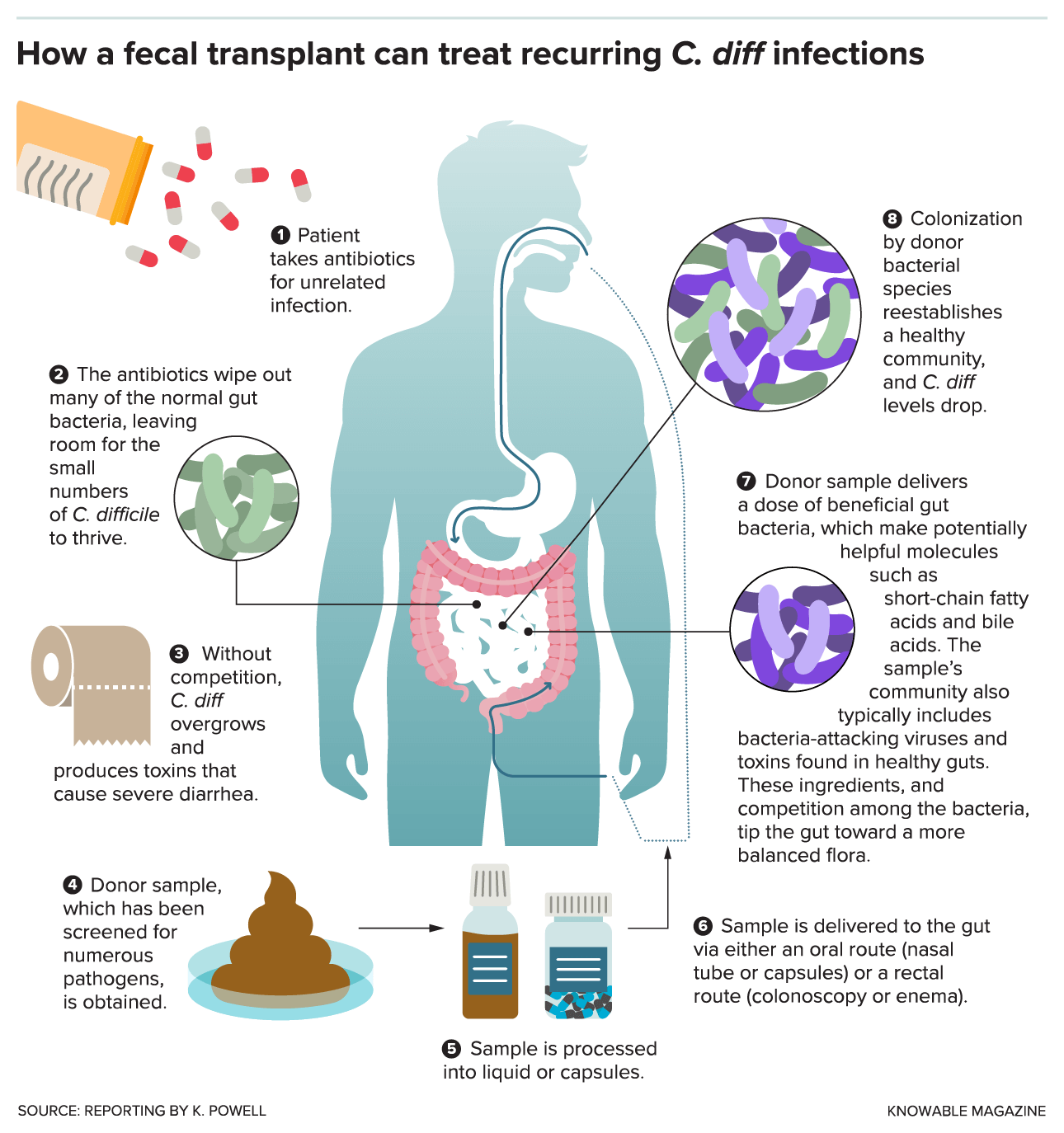 Infographic How Fecal Transplants Work Against Recurrent C Diff