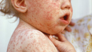 ps measles child x
