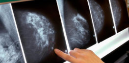 mammogram breast cancer x ray exlarge
