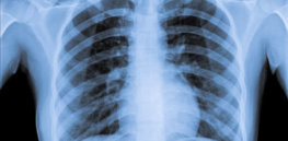 dt normal chest x ray x