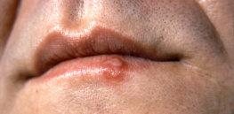 m secondary herpes simplex science photo library high