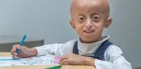 400 children worldwide are born each year with ‘fast-aging disease’ – Hutchinson-Gilford progeria syndrome. Now CRISPR offers hope