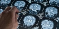 Looking past the aducanumab approval fiasco: 70 Alzheimer’s drugs are in the clinical pipeline