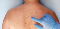 Skin cancer and screening: The good and the bad of ‘overdiagnosis’