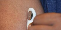 Peanut allergy-curing dermal patch shows promise