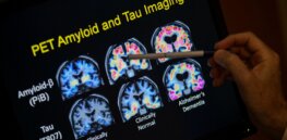 Are plaque deposits in the brain the true cause of Alzheimer’s disease?
